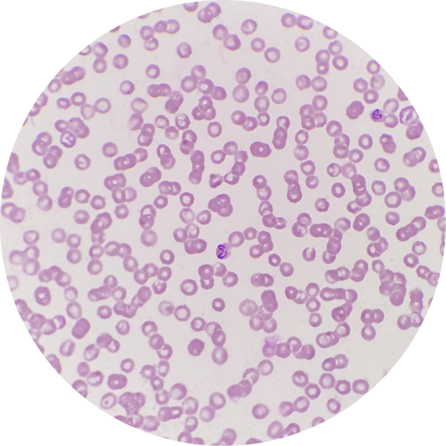 Babesiosis Micro